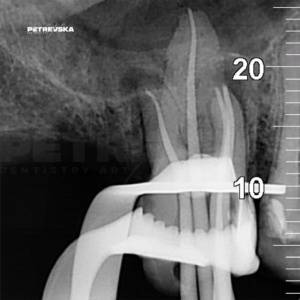 ендодонтски третман