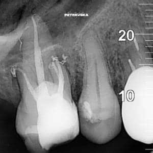 ендодонтски третман