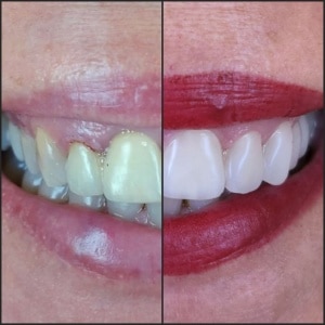 фасети/veneers